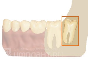 Описание: Медиальный (кпереди) наклон зуба мудрости - самый распространенный вид аномалии
