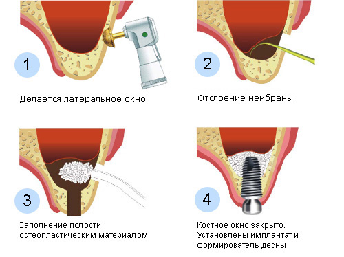 otkr-sinus