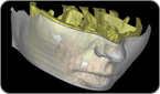 sinus-lifting